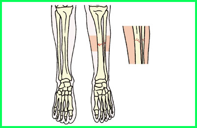 Kelainan ini disertai dengan nyeri punggung . Kunci Jawaban Kelas 5 Tema 1 Sub Tema 3 Pembelajaran 2 Masoyit