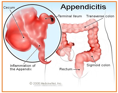 Semua orang pernah mengalami sulit buang air besar akibat feses keras. Biologi Gonzaga Gangguan Sistem Pencernaan