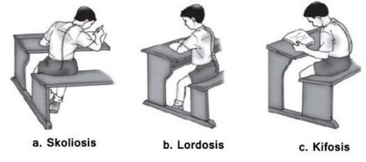 Pernahkah melihat seseorang yang memiliki tubuh bungkuk? Perhatikan Gambar Kelainan Tulang Berikut Kelainan Tulang Belakang Pada Gambar Disebut Blog Pak Pandani