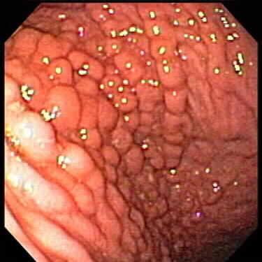 Radang akut pada lapisan mukosa dinding lambung disebut a. Nursyamsi And Reskiani