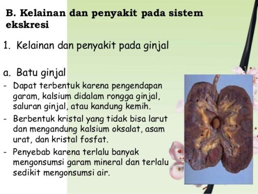 Download Terjadinya Pengendapan Garam Dan Kalsium Pada Rongga Ginjal Menyebabkan Penyakit
&nbsp;Pictures