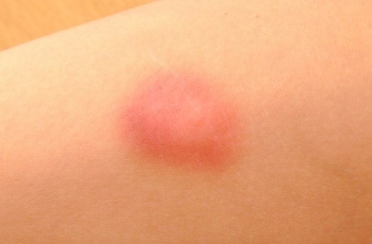 25+ Mengompres Menggunakan Air Es Pada Daerah Yang Memar Berguna Untuk&nbsp;Background