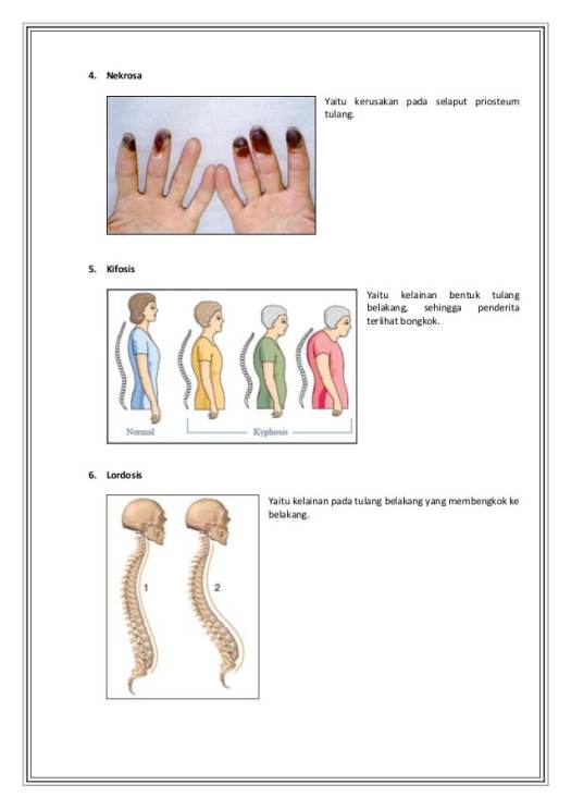 Get Sebutkan Gangguan Ataupun Kelainan Dan Penyakit Pada Sistem Gerak Manusia
&nbsp;Pictures